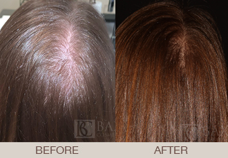 treatment for hair loss caused by cocaine